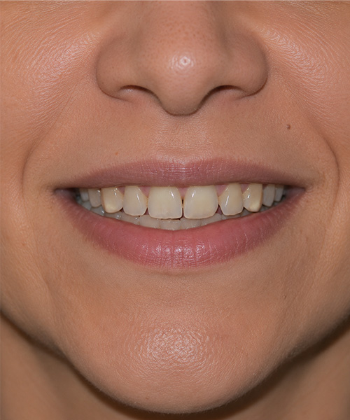 Antes