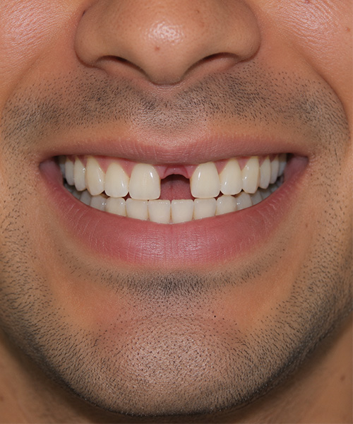 Antes