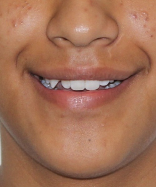 Antes
