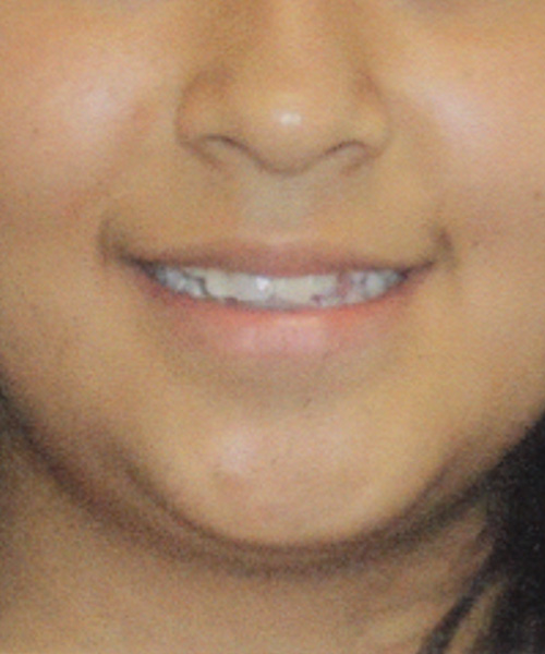 Antes