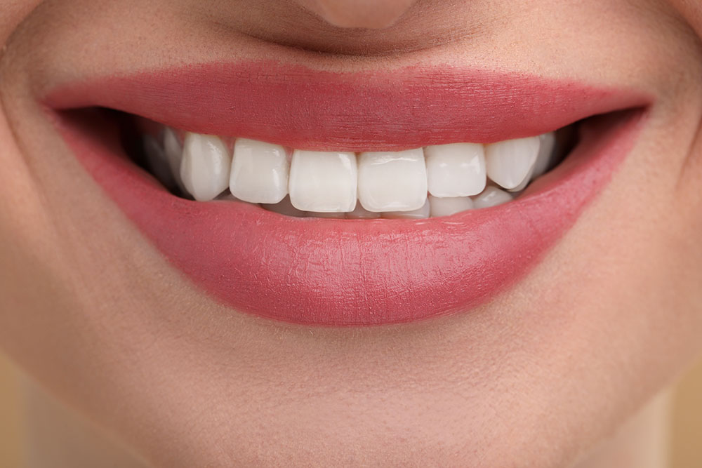 Carillas dentales: La inversión definitiva en estética facial y “Lujo Silencioso”