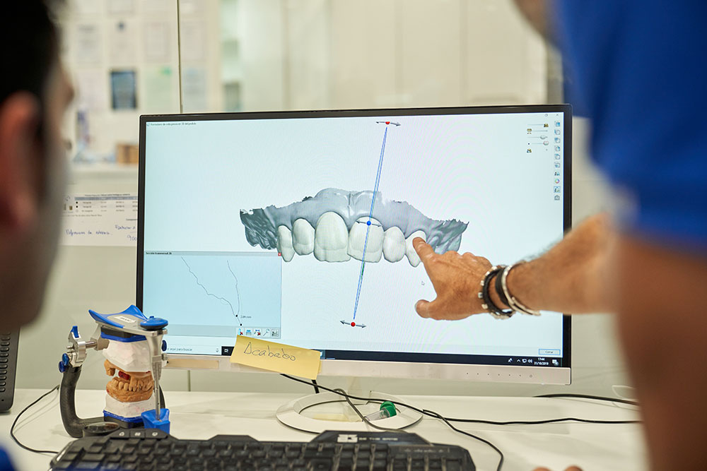 Coronas dentales en un solo día: La ventaja de la tecnología y el flujo digital CAD/CAM